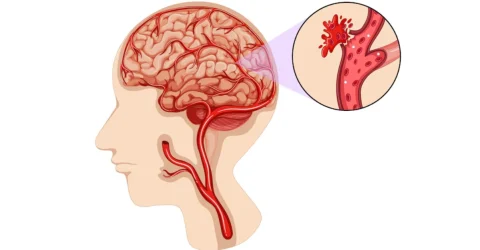 মস্তিষ্কে রক্তক্ষরণ: কারণ, লক্ষণ ও প্রতিরোধ