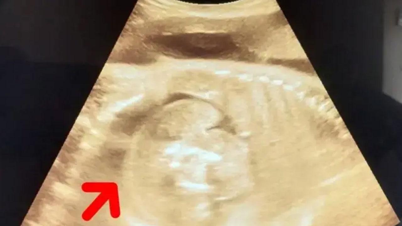 নারীর গর্ভে থাকা শিশুর গর্ভে মিলল আরও একটি ভ্রূণ