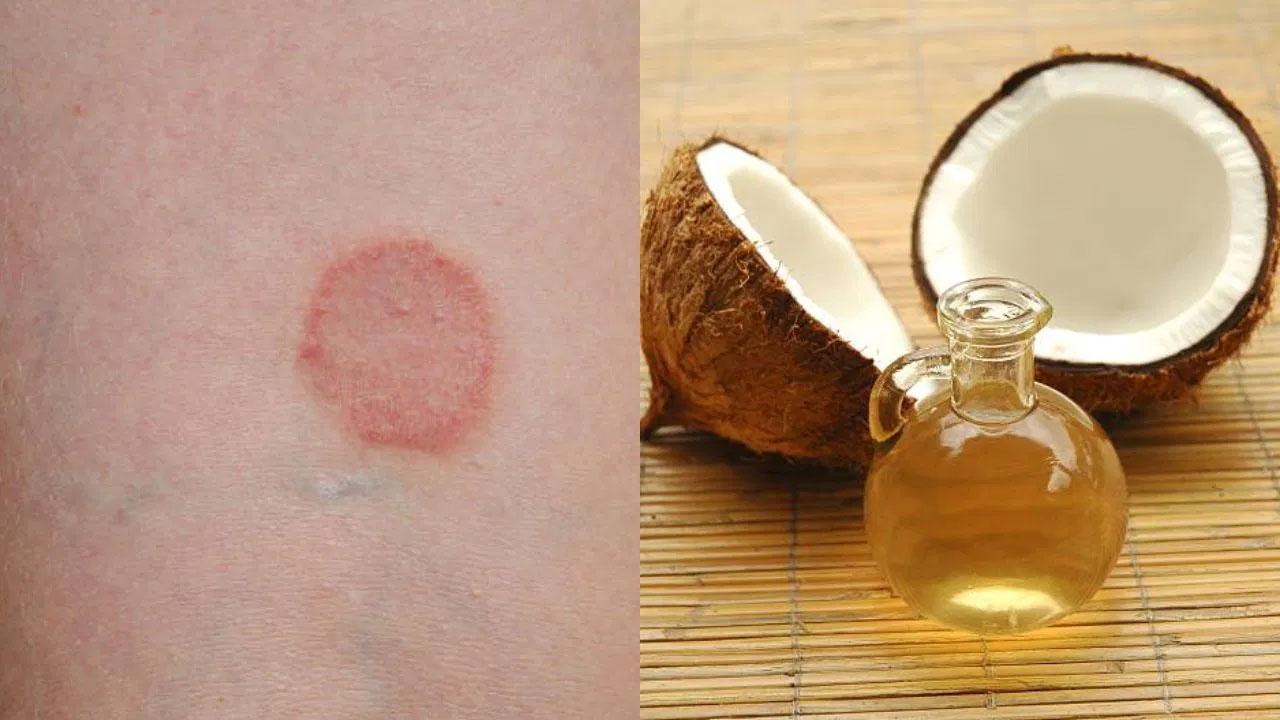 তীব্র চুলকানি ও অস্বস্তির দাদ থেকে মুক্তির উপায় জেনে নিন