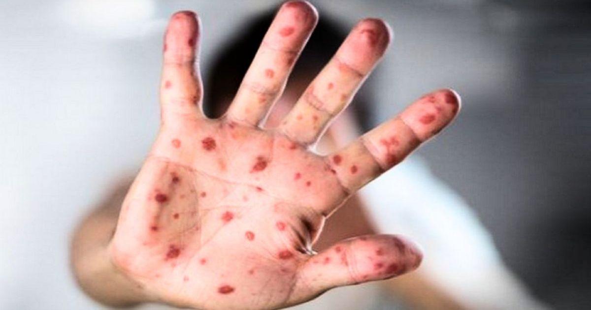 হাম ও উপসর্গে আরও ৭ জনের মৃত্যু